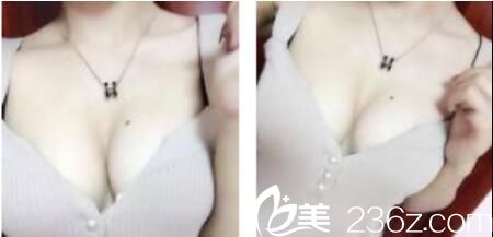 韓國樸賢整形外科樸賢自體脂肪隆胸真人案例術(shù)后一個(gè)月 韓國樸賢整形外科樸賢自體脂肪隆胸真人案例術(shù)后一個(gè)月