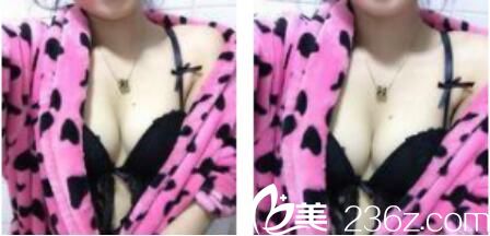 韓國樸賢整形外科樸賢自體脂肪隆胸真人案例術(shù)后三個(gè)月 韓國樸賢整形外科樸賢自體脂肪隆胸真人案例術(shù)后三個(gè)月