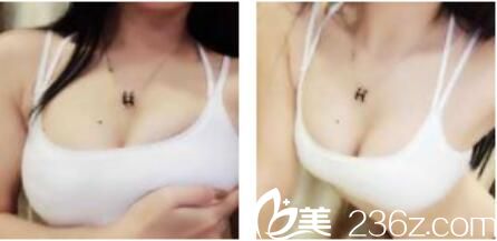 韓國樸賢整形外科隆胸技術(shù)怎么樣？看樸賢一年前為我做的自體脂肪隆胸現(xiàn)在維持的特別好