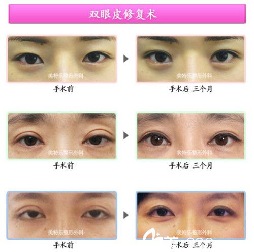 洪政槿院長(zhǎng)雙眼皮修復(fù)手術(shù)案例