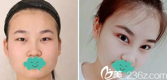 藝雅特整形醫(yī)院雙眼皮+內(nèi)開眼角案例效果對比圖