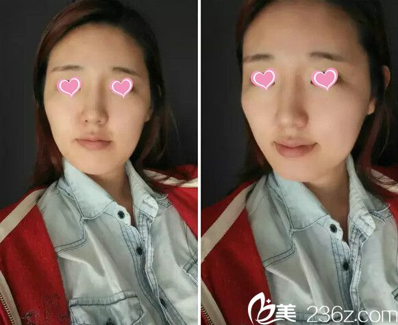 手術(shù)前照片 手術(shù)前照片