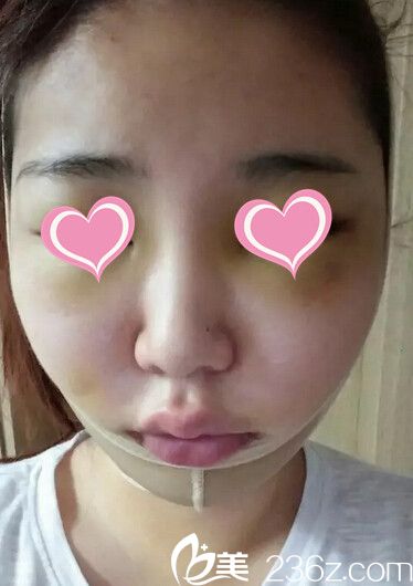 顴骨手術(shù)后1天 顴骨手術(shù)后1天