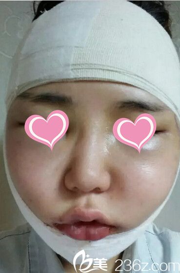 下頜角手術(shù)后2天 下頜角手術(shù)后2天