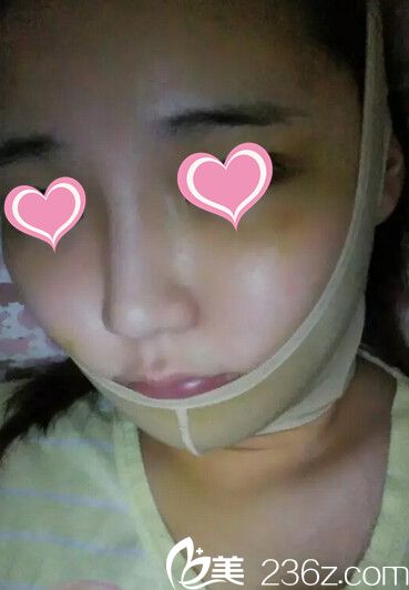 下巴手術(shù)后7天 下巴手術(shù)后7天