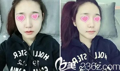 面部輪廓術(shù)后20天 面部輪廓術(shù)后20天