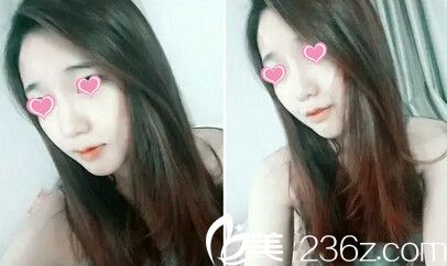 洪政槿院長(zhǎng)面部輪廓手術(shù)案例 洪政槿院長(zhǎng)面部輪廓手術(shù)案例