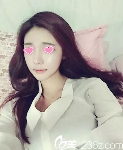 藝校妹子在韓國(guó)美特樂(lè)整形做了下頜角整形、下巴整形、顴骨縮小和面部脂肪填充