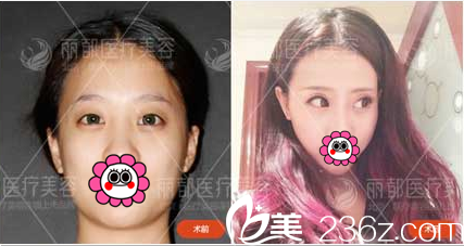 北京米蘭柏羽麗都曹衛(wèi)華韓式雙眼皮案例