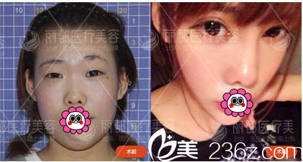 北京米蘭柏羽麗都于曉春切開雙眼皮開眼角案例