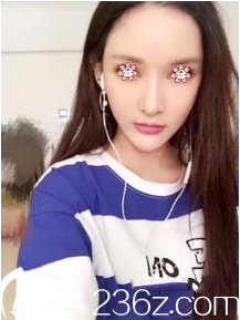 <!--<i data=20240703-sp></i>-->臉部埋線提升術(shù)后一個(gè)月 <!--<i data=20240703-sp></i>-->臉部埋線提升術(shù)后一個(gè)月