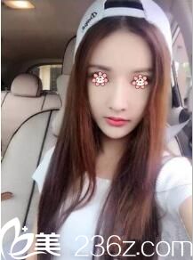 因?yàn)橄嘈彭n國整容技術(shù)我去找了韓國NU整形做全面部PPDO埋線提升。