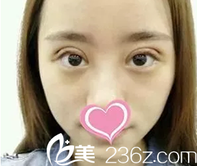 我在大同美神做韓式三點雙眼皮術(shù)后第3天照片 我在大同美神做韓式三點雙眼皮術(shù)后第3天照片