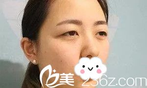 雙眼皮手術(shù)前 雙眼皮手術(shù)前