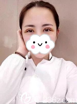 雙眼皮手術(shù)后3天 雙眼皮手術(shù)后3天