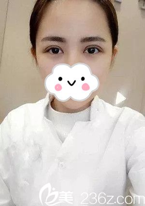 千載玄院長(zhǎng)雙眼皮手術(shù)案例 千載玄院長(zhǎng)雙眼皮手術(shù)案例