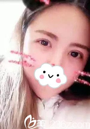 趁著出差在韓國(guó)摩茲整形讓千載玄院長(zhǎng)給我做了雙眼皮手術(shù)，恢復(fù)的很自然