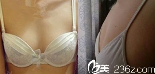 沒(méi)有在合肥壹加壹找<!--<i data=20240703-sp></i>-->做自體脂肪豐胸之前 沒(méi)有在合肥壹加壹找<!--<i data=20240703-sp></i>-->做自體脂肪豐胸之前