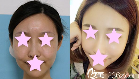 藝雅特整形外科文盛準醫(yī)生面部填充案例 藝雅特整形外科文盛準醫(yī)生面部填充案例