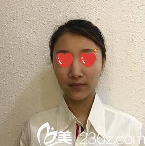 在韓國M整形醫(yī)院做鼻綜合術(shù)前照 在韓國M整形醫(yī)院做鼻綜合術(shù)前照