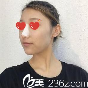 綜合立體隆鼻術(shù)后天照 綜合立體隆鼻術(shù)后天照
