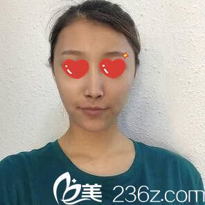 在M整形醫(yī)院做鼻綜合術(shù)后一周 在M整形醫(yī)院做鼻綜合術(shù)后一周