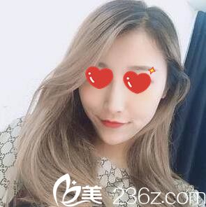 分享暑假我在韓國M整形醫(yī)院做的綜合立體隆鼻術(shù)后一個(gè)月恢復(fù)效果圖