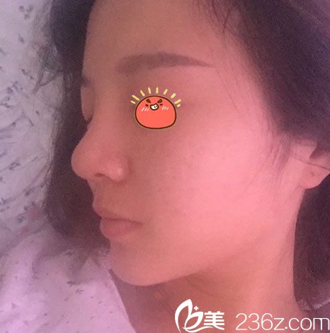 在金華亞美做隆鼻手術(shù)前 在金華亞美做隆鼻手術(shù)前