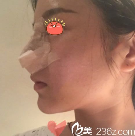 剛做完鼻綜合隆鼻手術(shù)圖片 剛做完鼻綜合隆鼻手術(shù)圖片