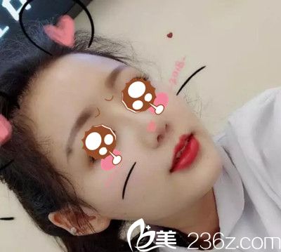 在國(guó)內(nèi)面診了多家醫(yī)院，較后還是去韓國(guó)摩茲整形找孫承用做了鼻綜合