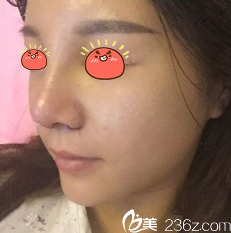 找金華亞美鄧澤臣隆鼻5天拆線圖 找金華亞美鄧澤臣隆鼻5天拆線圖