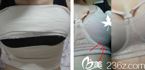 <!--<i data=20240703-sp></i>-->自體脂肪隆胸第4天恢復(fù)情況 <!--<i data=20240703-sp></i>-->自體脂肪隆胸第4天恢復(fù)情況