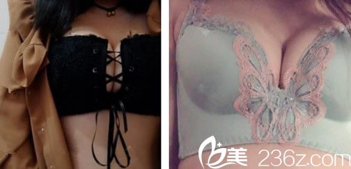 合肥壹加壹自體脂肪豐胸第10天照片 合肥壹加壹自體脂肪豐胸第10天照片