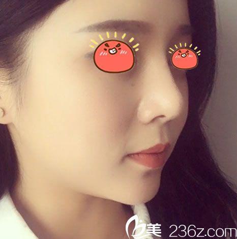 金華亞美做鼻綜合30天恢復(fù)照 金華亞美做鼻綜合30天恢復(fù)照