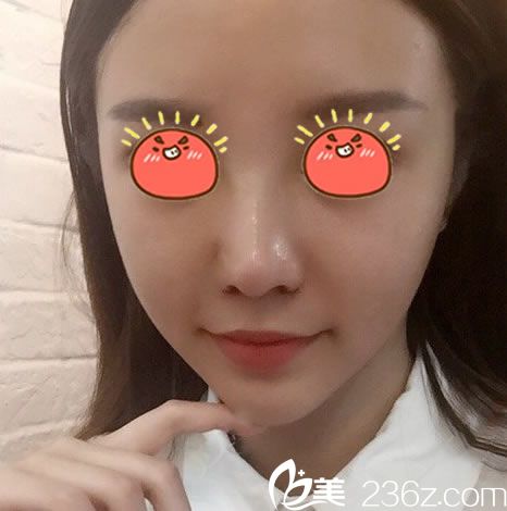 做完膨體隆鼻手術(shù)15天恢復(fù)照 做完膨體隆鼻手術(shù)15天恢復(fù)照