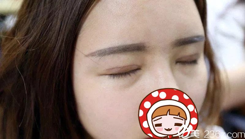 肉條感雙眼皮修復(fù)一周后恢復(fù)