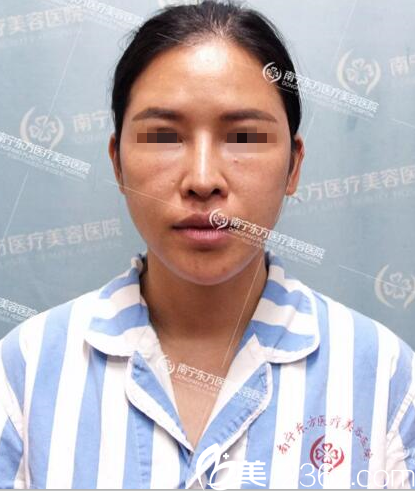 在南寧東方做鼻修復(fù)手術(shù)前 在南寧東方做鼻修復(fù)手術(shù)前