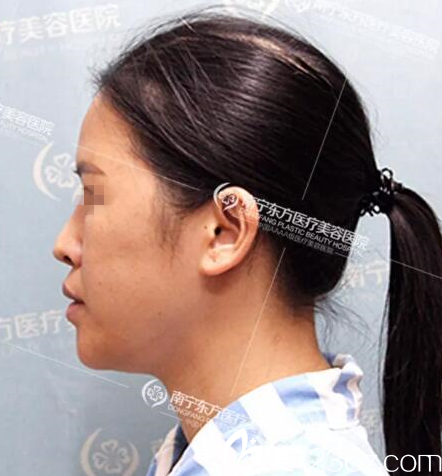 在南寧東方做鼻修復(fù)手術(shù)側(cè)面照 在南寧東方做鼻修復(fù)手術(shù)側(cè)面照