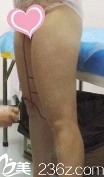 術(shù)前大腿粗壯 術(shù)前大腿粗壯