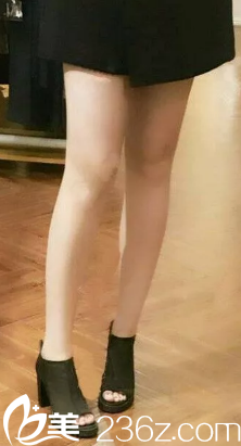 大腿吸脂20天腿部完全消腫 大腿吸脂20天腿部完全消腫