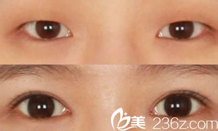 杭州維多利亞假體雙眼皮案例圖 杭州維多利亞假體雙眼皮案例圖