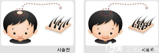 韓國延世毛百麗植發(fā)毛發(fā)移植優(yōu)勢 韓國延世毛百麗植發(fā)毛發(fā)移植優(yōu)勢