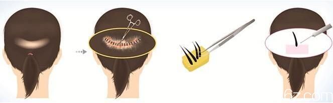 韓國延世毛百麗植發(fā)楊泫準毛發(fā)移植手術過程 韓國延世毛百麗植發(fā)楊泫準毛發(fā)移植手術過程