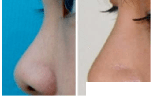 韓國尚美佳整形醫(yī)院隆鼻手術(shù)案例 韓國尚美佳整形醫(yī)院隆鼻手術(shù)案例