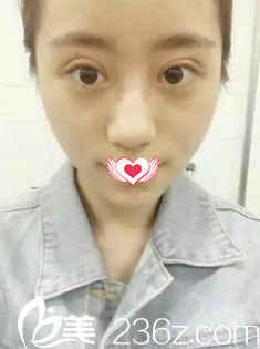 剛做完雙眼皮手術(shù)眼睛腫脹 剛做完雙眼皮手術(shù)眼睛腫脹