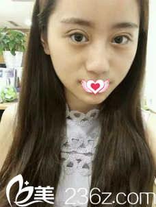 術(shù)后7天雙眼皮拆線后的樣子 術(shù)后7天雙眼皮拆線后的樣子