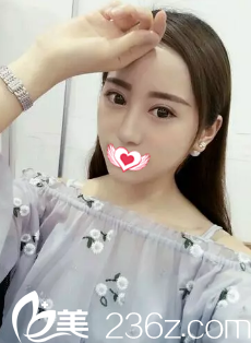 恢復(fù)20天的雙眼皮完全消腫 恢復(fù)20天的雙眼皮完全消腫