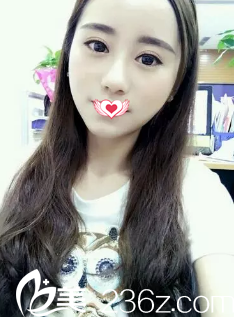 廊坊哪里做雙眼皮效果好?來(lái)看內(nèi)雙的我找艾美醫(yī)生做切開雙眼皮后擁有明眸大眼