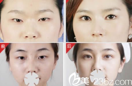 無錫愛思特整形醫(yī)院雙眼皮開眼角效果對比圖 無錫愛思特整形醫(yī)院雙眼皮開眼角效果對比圖