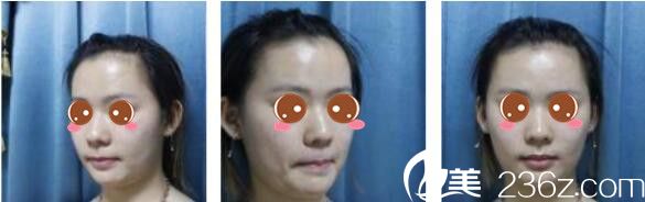 韓國(guó)延世毛百麗植發(fā)中心楊泫準(zhǔn)毛發(fā)移植真人案例術(shù)前照 韓國(guó)延世毛百麗植發(fā)中心楊泫準(zhǔn)毛發(fā)移植真人案例術(shù)前照